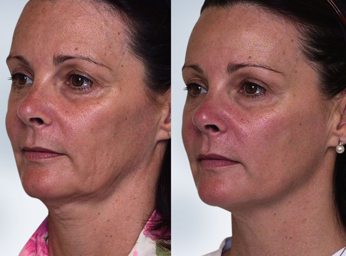 Sculptra Treatment Bedford Skin Clinic