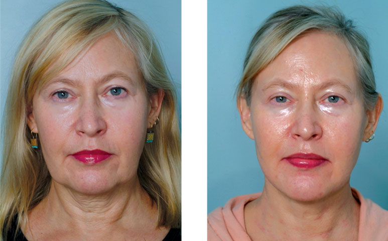 Skin Tightening Treatment Bedford Skin Clinic